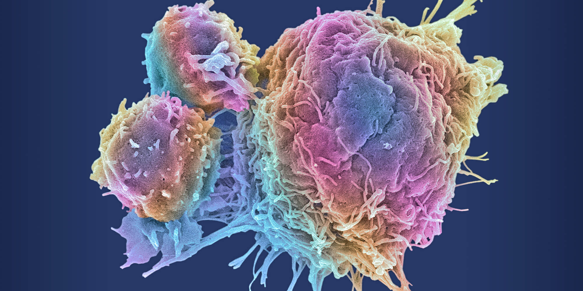 Cancer | Loyola Medicine