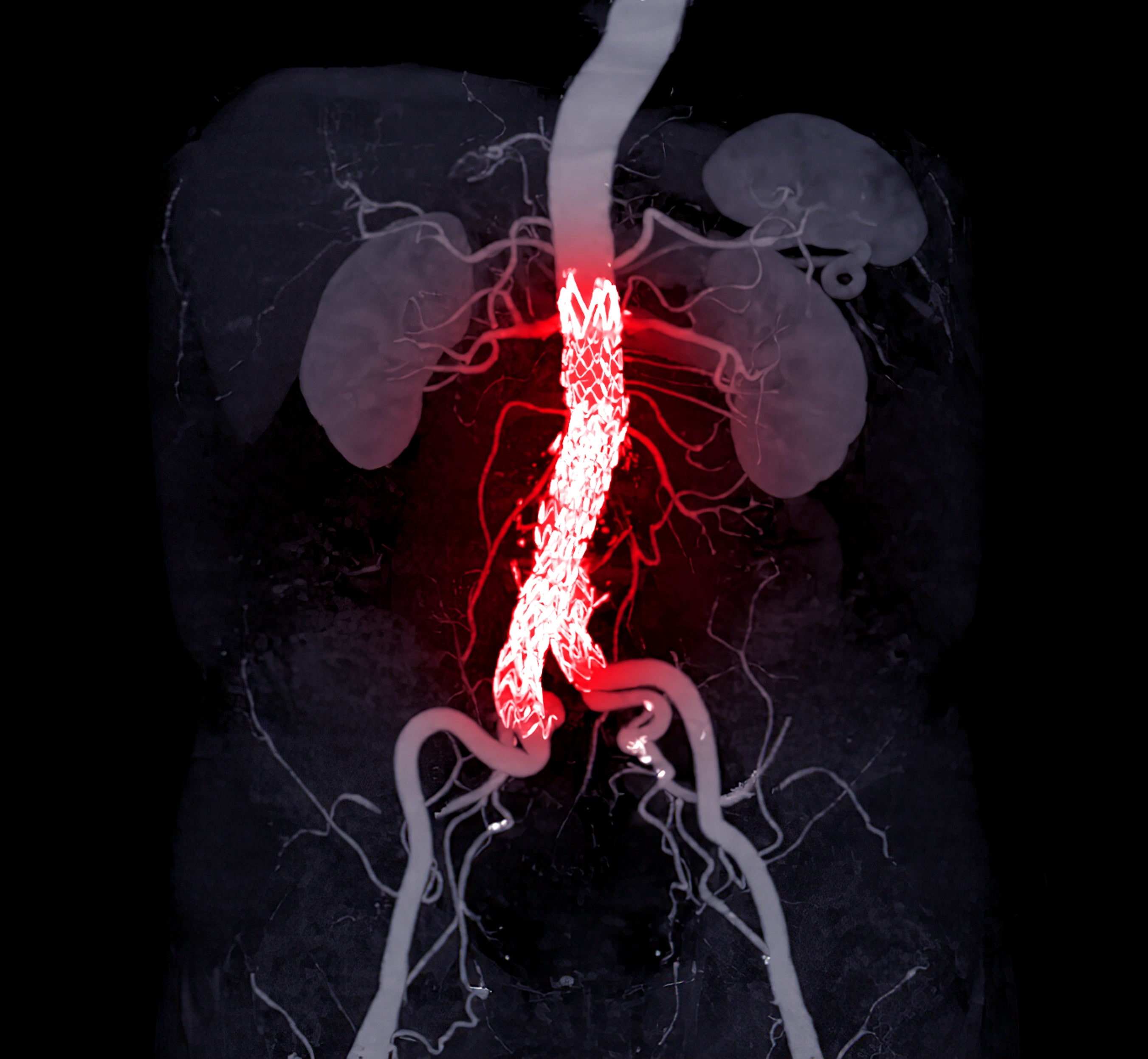 Abstract aneurysm graphic
