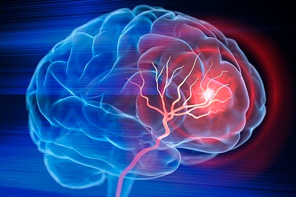 stroke brain
