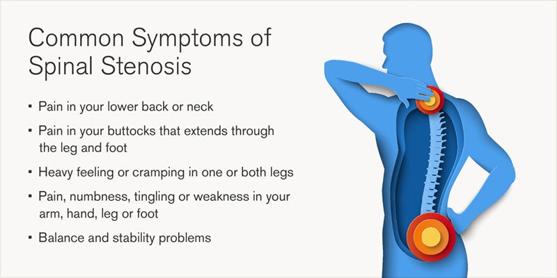 Spinal Stenosis Symptoms Treatment Blog Loyola Medicine Spinal Stenosis Symptoms Treatment Blog Loyola Medicine