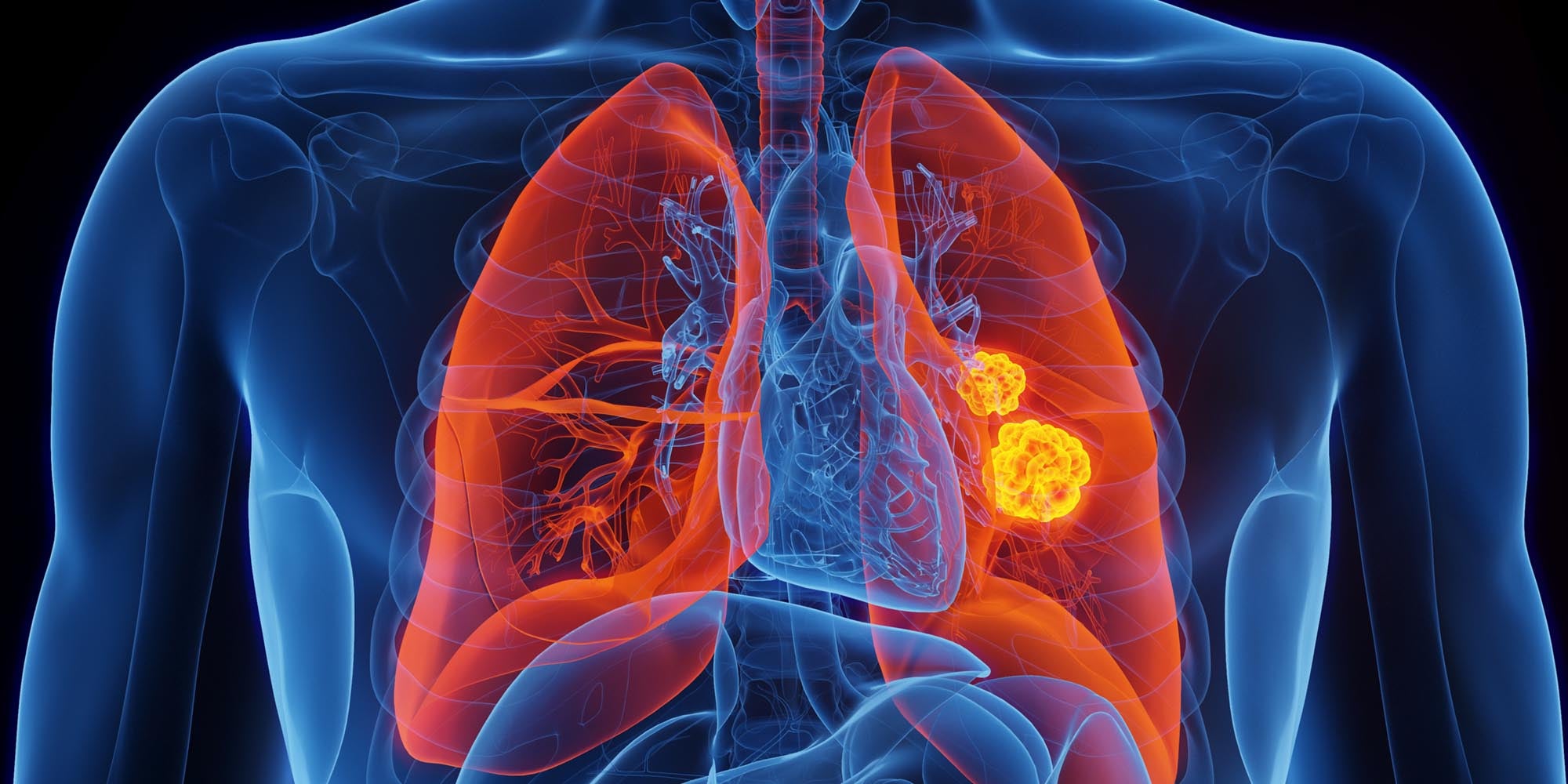 Lung and Thoracic Cancer Experts 